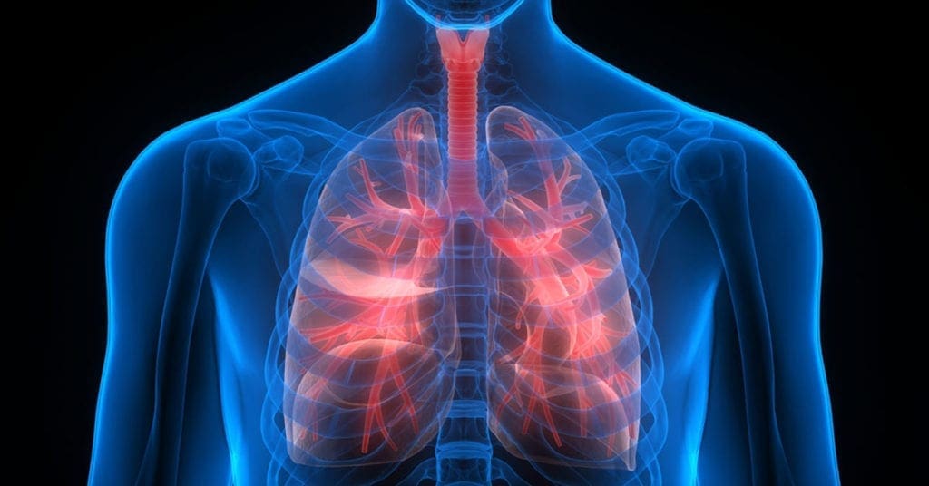 pneumonia 1