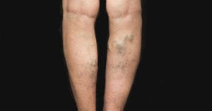 varizes veias fora de funcionamento