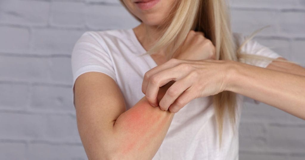 dermatite atopica