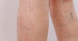 Trombose venosa e viagens aéreas de longa distância