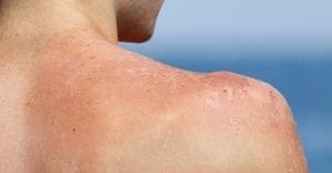 Campanha Dezembro Laranja de prevenção ao câncer de pele tem adesão da Poupafarma