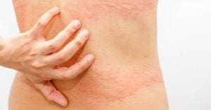 Urticária: conheça os tipos da doença e os mitos em torno dela