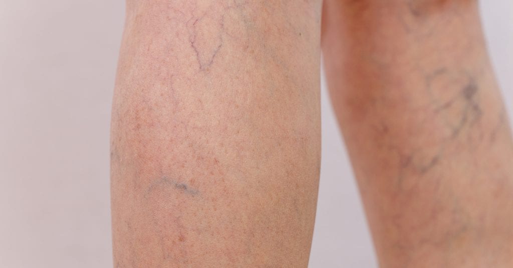 pacientes-com-covid-19-apresentam-quadros-de-trombose