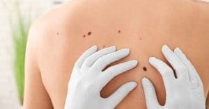 Cinco alertas sobre o câncer de pele