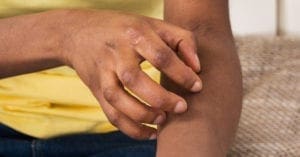 4 formas de prevenir a dermatite atópica