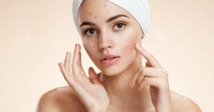 10 dicas para evitar o aparecimento de espinhas