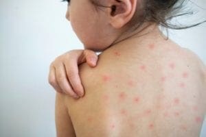 Quando suspeitar do sarampo em crianças?