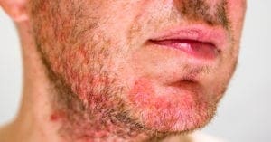 Foliculite: o que é, como tratar e prevenção