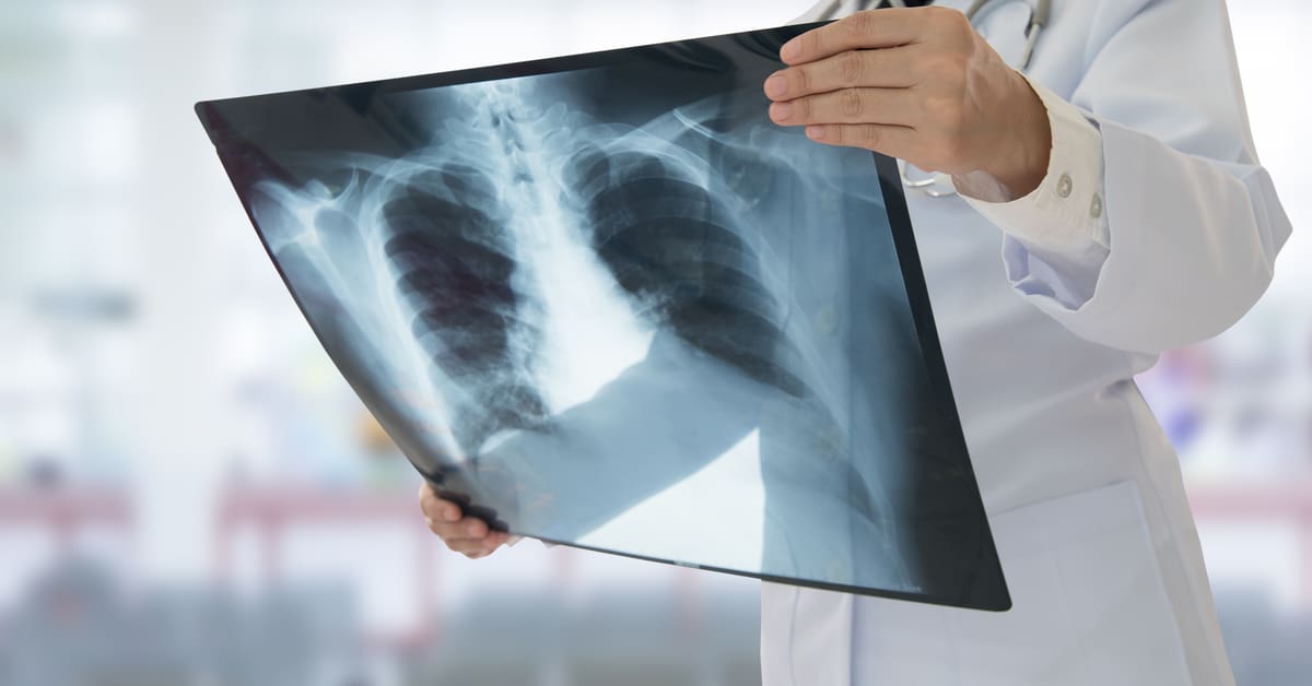 pneumonia