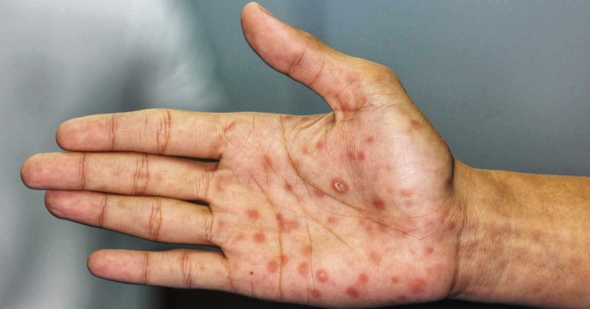 mão-sintomas-sífilis