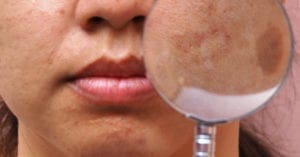 Como tratar melasma, manchas de acne e pele oleosa