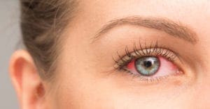 Alergia afeta cerca de 35% dos brasileiros