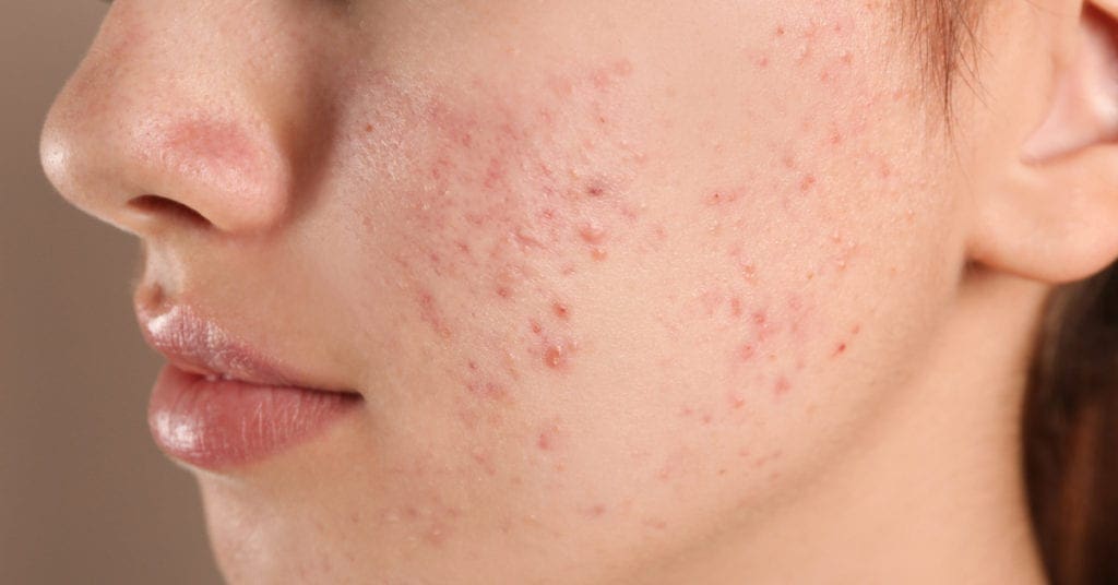 acne-máscara