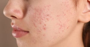 Acne provocada pelo uso de máscara contra Covid-19 turbina venda de produto de pele