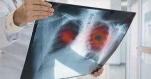 Anvisa aprova nova terapia oral para câncer de pulmão avançado