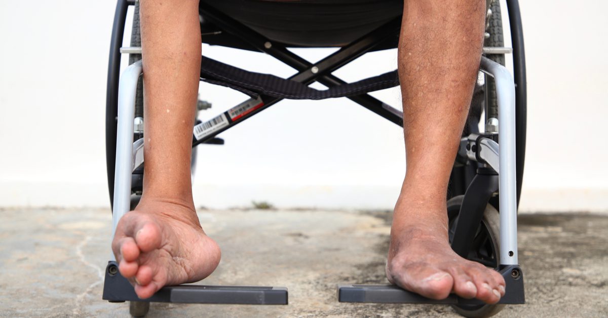 sequelas-poliomelite