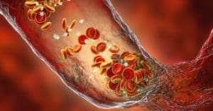 “Trombose: quais as causas e como evitar” é o tema da próxima live promovida pelo Grupo DPSP