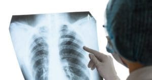 Cientistas descobrem por que Covid-19 causa inflamação grave em alguns pacientes