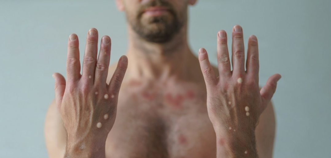 guia da farmácia agosto varíola de macacos