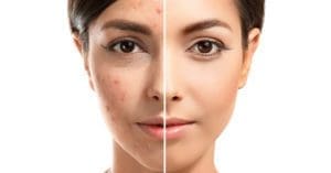 Antiacneicos venderam R$1.288.918.801 no MAT 2022/06