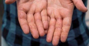Desidrose: dermatologista tira dúvidas sobre a doença