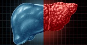 NASH: o que é, sintomas e como prevenir
