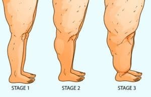 10 sinais para identificar o lipedema