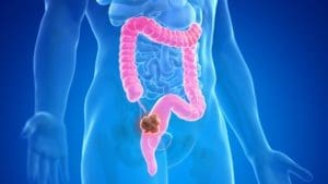 Por que o câncer de intestino é cada vez mais comum antes dos 50?