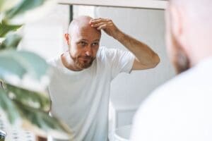 É possível parar a calvície? Veja como funcionam remédios como finasterida e minoxidil