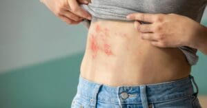 Herpes Zoster: conheça os sintomas