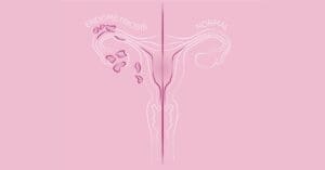 Endometriose e sistema imunológico: existe alguma relação entre os dois?