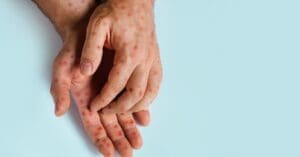 São Paulo implanta teste para detectar nova variante da mpox