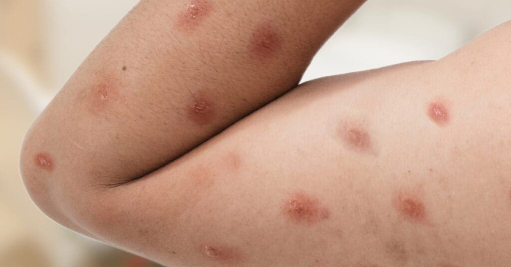 Anvisa-renova-dispensa-de-registro-de-duas-vacinas-contra-mpox