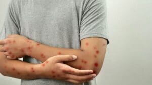 Casos de mpox passam de 100 mil em todo o mundo, diz OMS