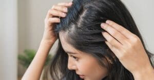 Alopecia Areata: o que é como identificar