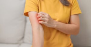 Dermatite Atópica: o que você precisa saber