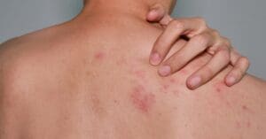 Herpes zoster: reações graves demandam atenção