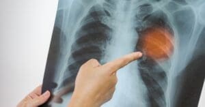 Pneumonia: vacinação é a principal forma de prevenção