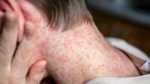 Estado de São Paulo registra primeiro caso de sarampo em 2025