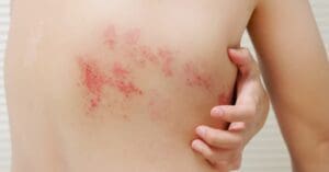 Herpes-zóster: conheça causas, sintomas e tratamento