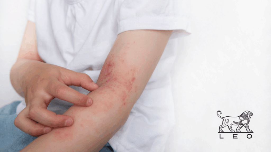 dermatite-atopica-doenca-multifatorial